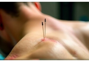 The Science Behind Acupuncture Therapy for Nerve Pain
