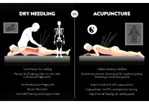 The Truth About Dry Needling vs Acupuncture Differences