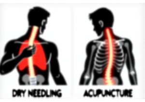 Dry Needling Vs Acupuncture Key Differences Explained