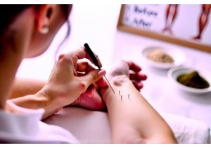 Acupuncture for Weight Loss Safe and Effective Natural Method