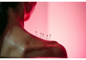 Acupuncture in Assisted Reproduction Improving IVF Success Rates